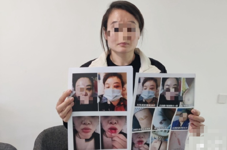 鄭州一女子稱被企業家丈夫長期家暴,起訴離婚要撫養權